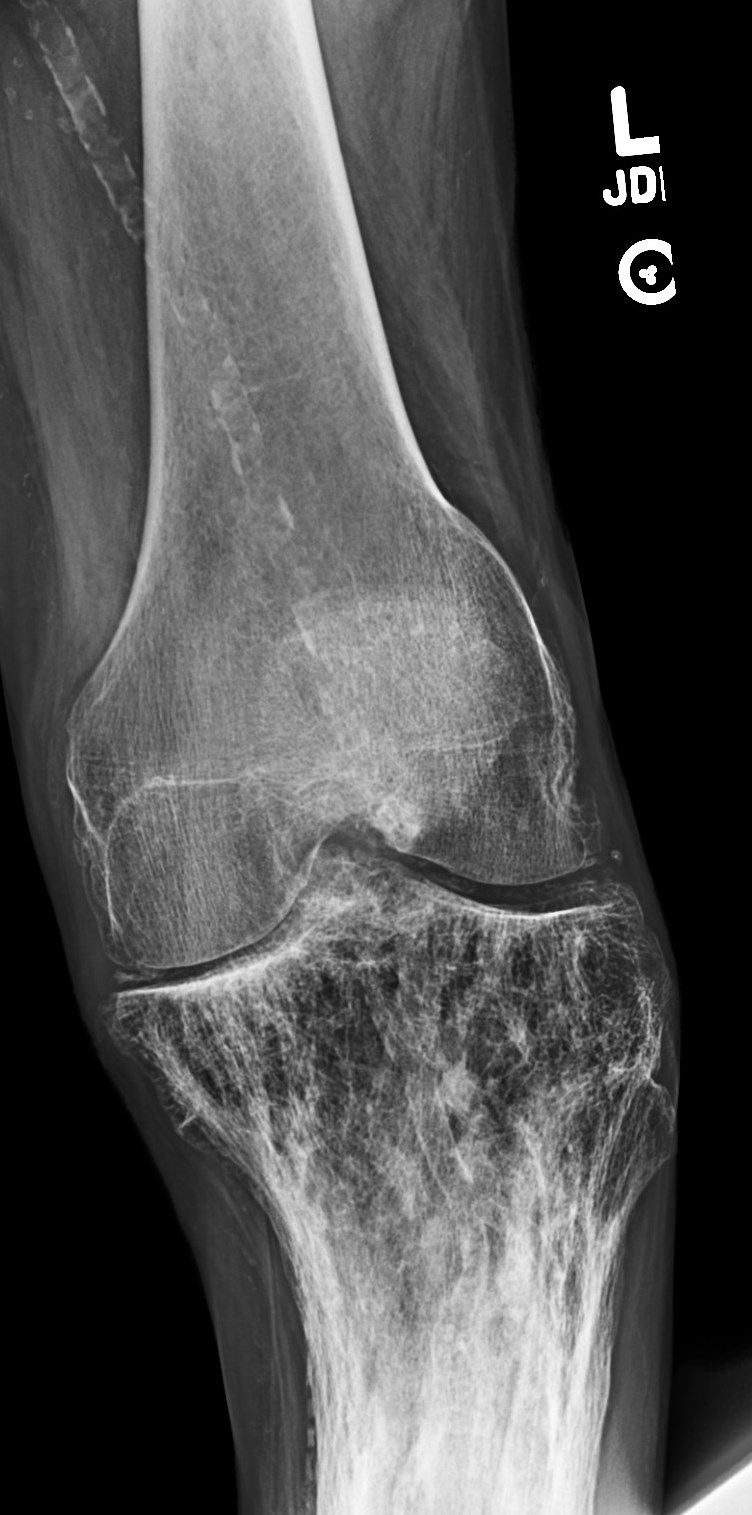 Figure 3 for case Pagets disease ( RID3815 )